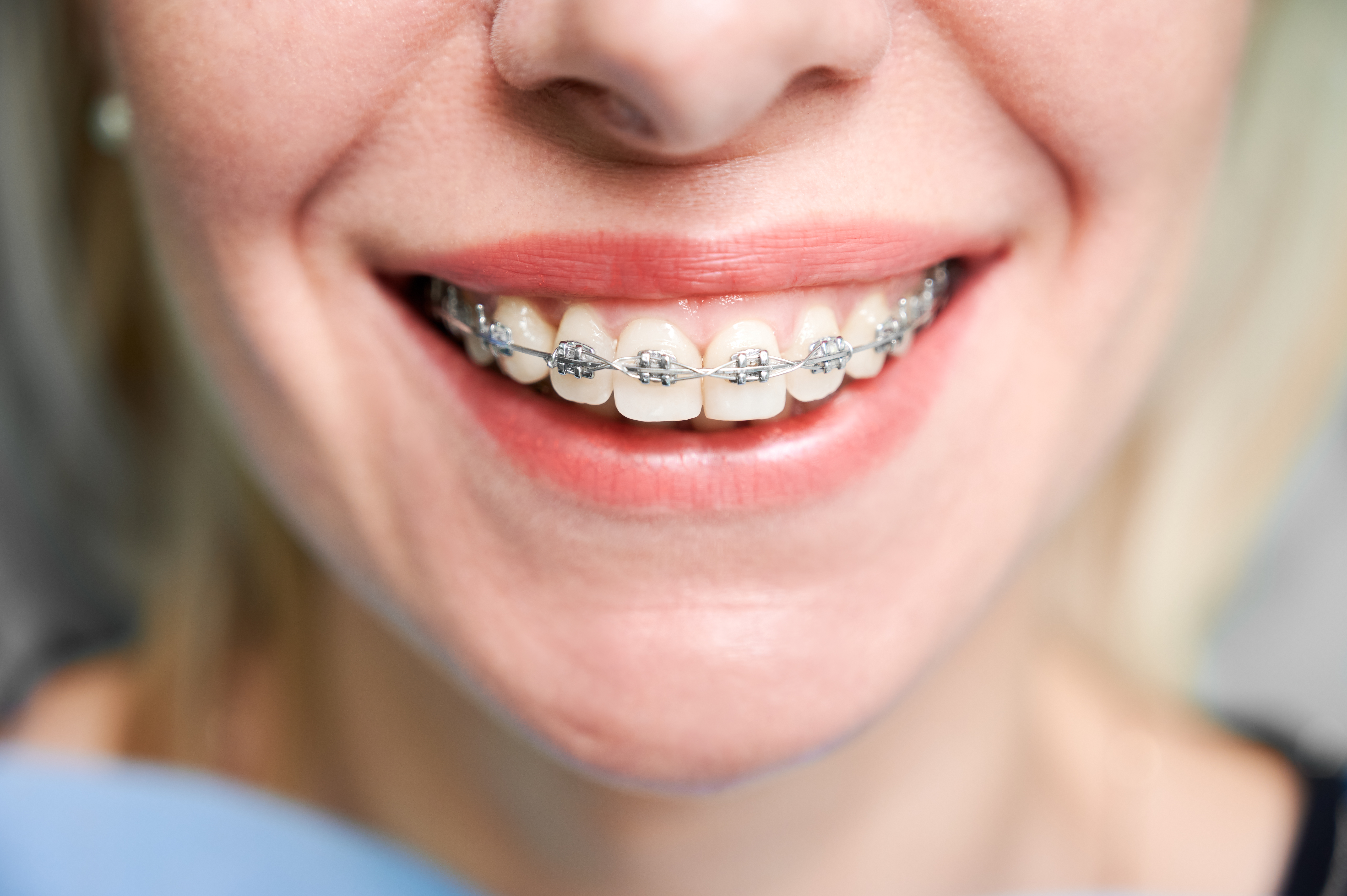 Can You Eat Salad With Braces? Foods to Watch For