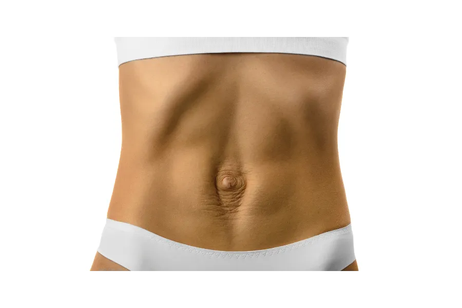 Diastasis Recti