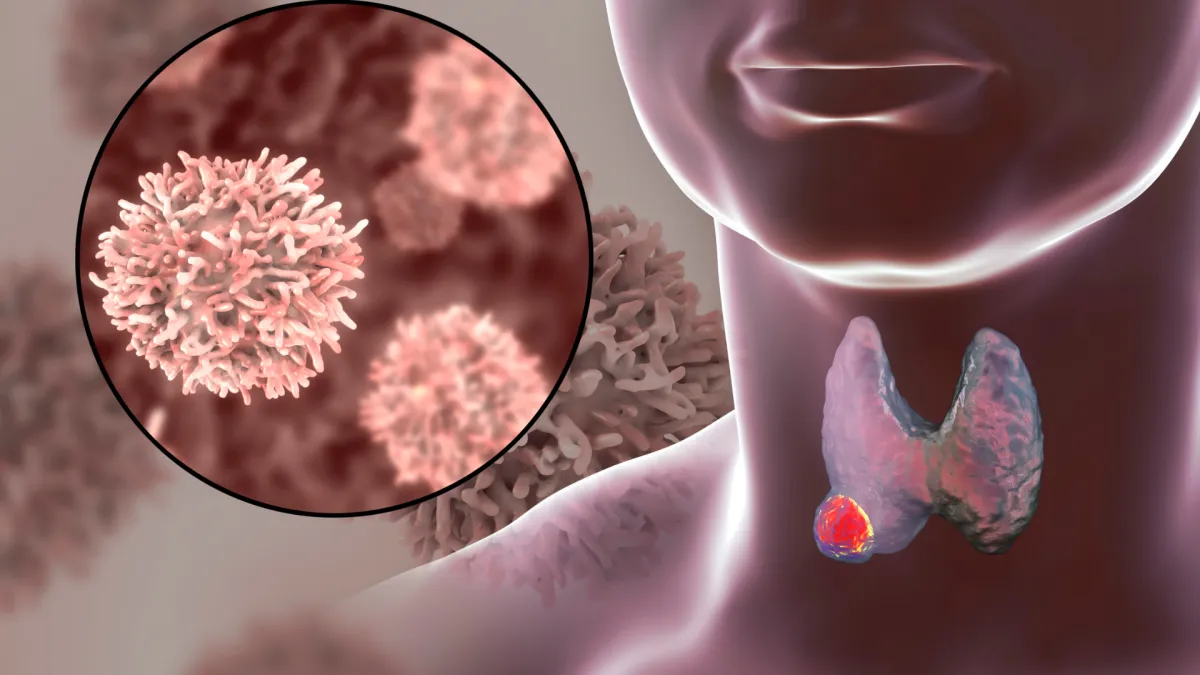 antibodies attacking thyroid glandd