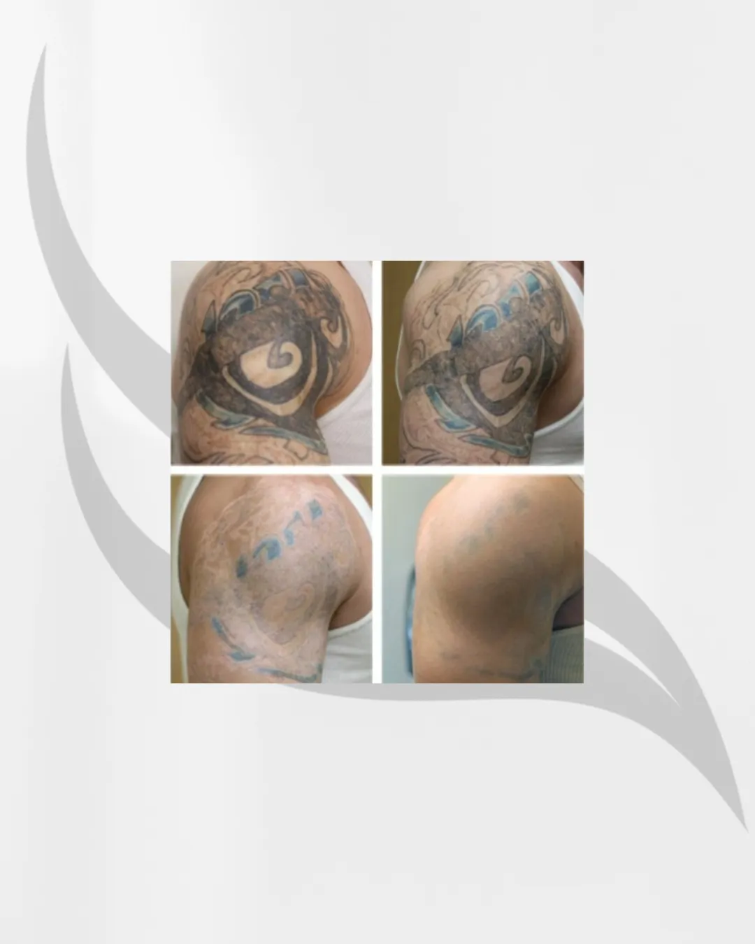 Absztrakt, művészi ábrázolású diódalézer berendezés