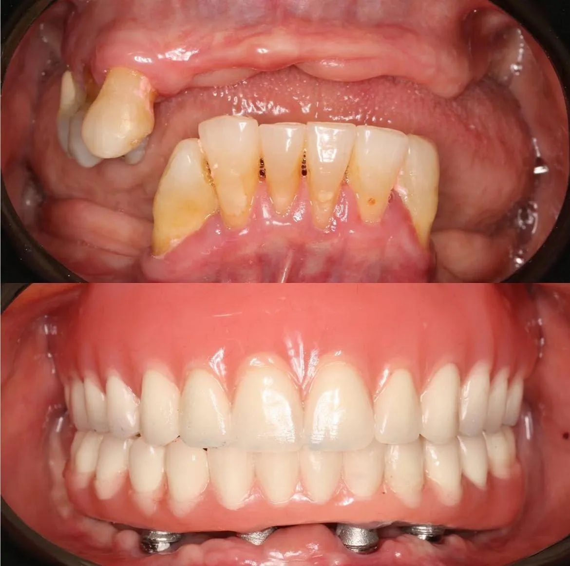 Resultado de paciente - Rinoplastia