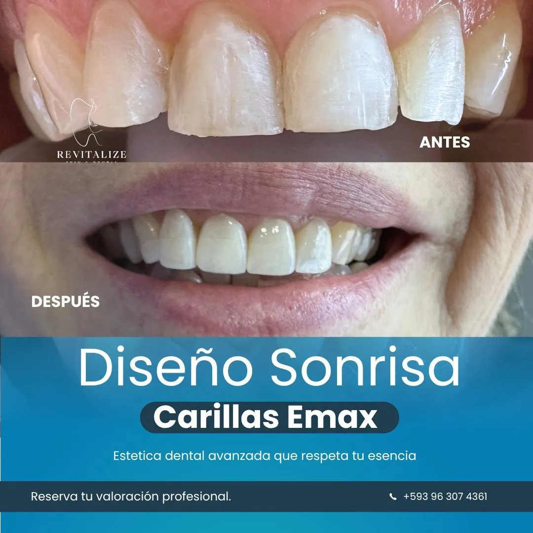 Resultado de paciente - Mamoplastia