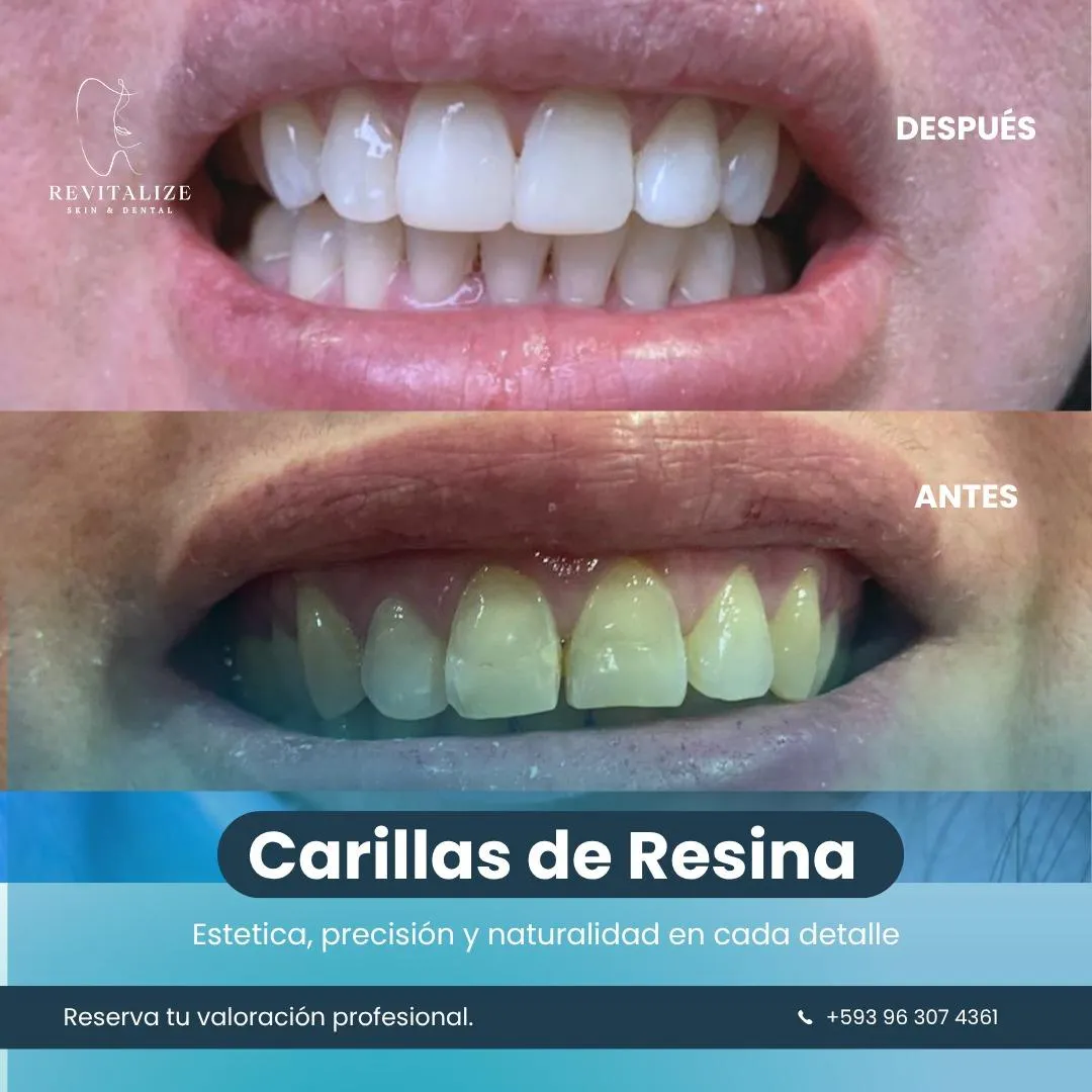 Resultado de paciente - Abdominoplastia