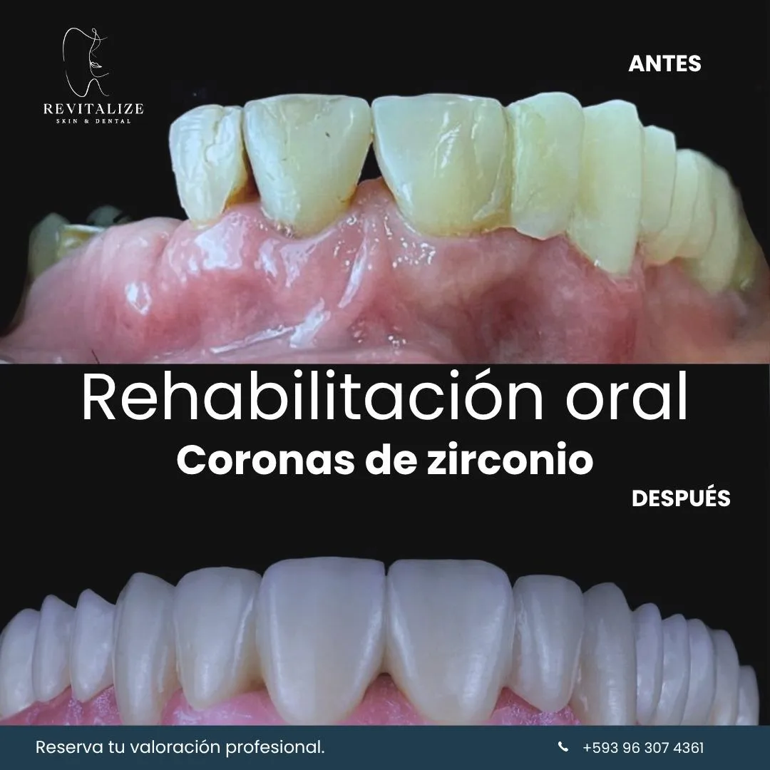 Resultado de paciente - Lifting Facial