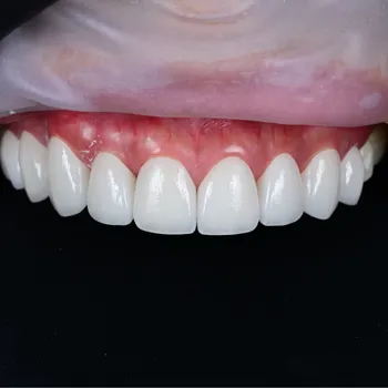 Dentures
