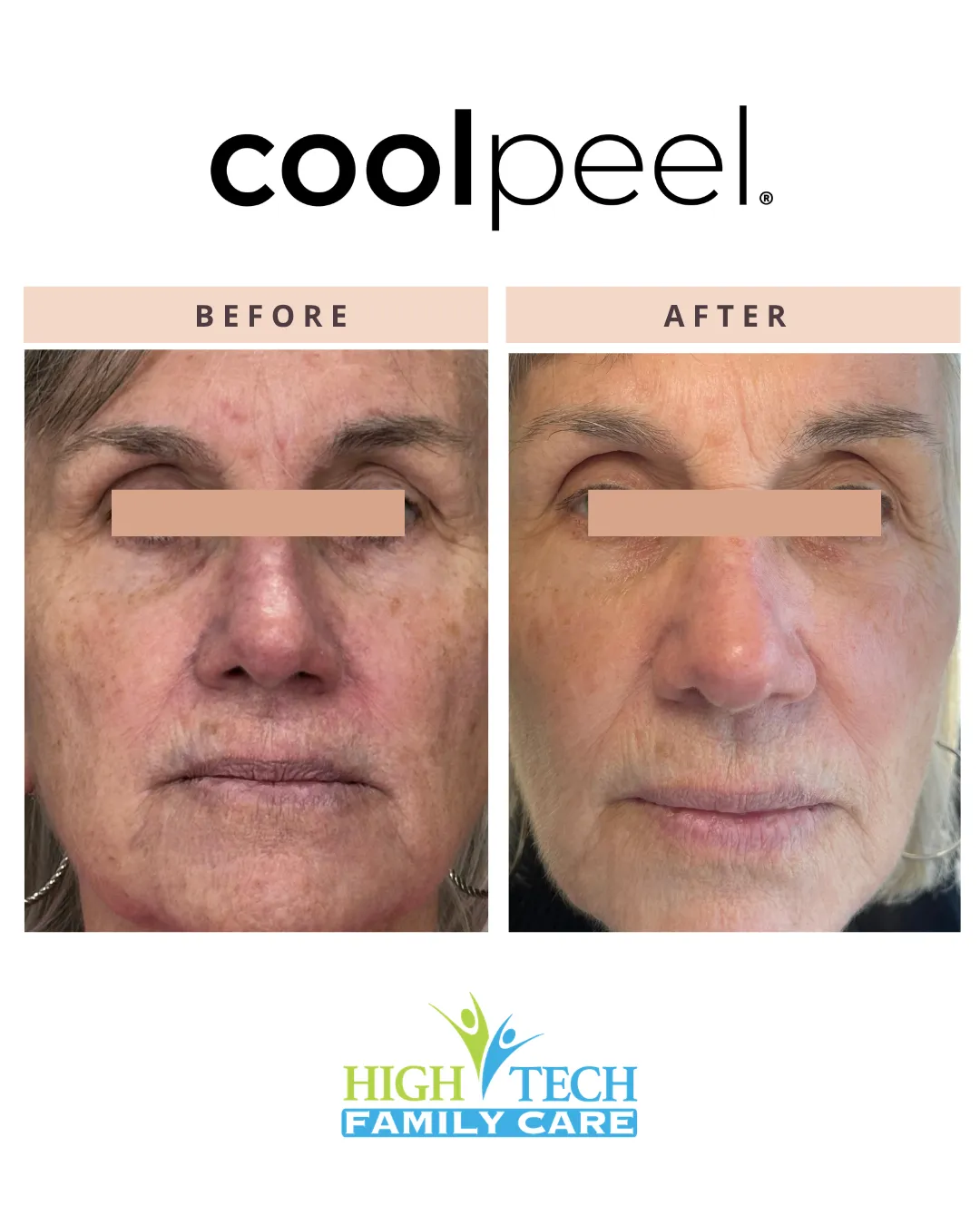 Clinical CoolPeel device or healthy natural skin