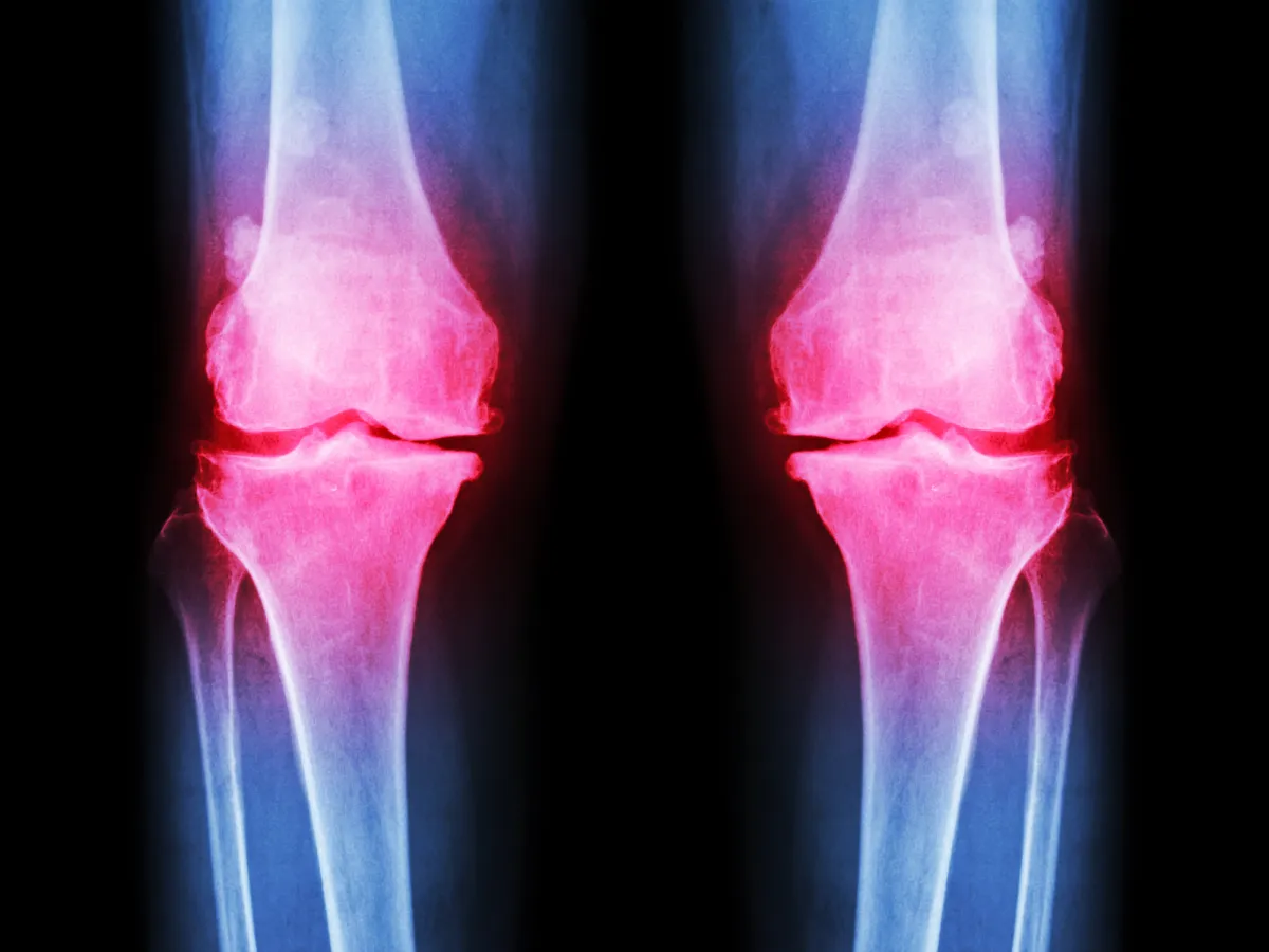Bone on bone knee pain imaging