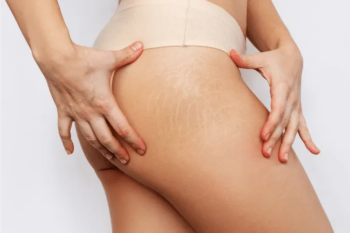 Pregnancy is one of the reasons why stretch marks occur