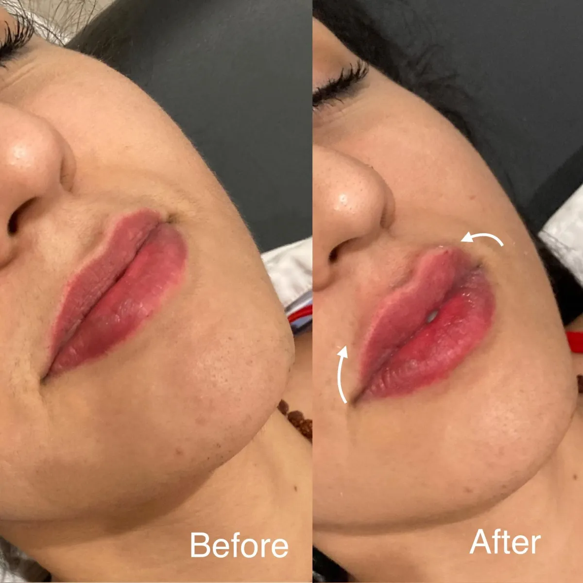 Before and after look of lip enhancement using non invasive approach with the hyaluron pen 