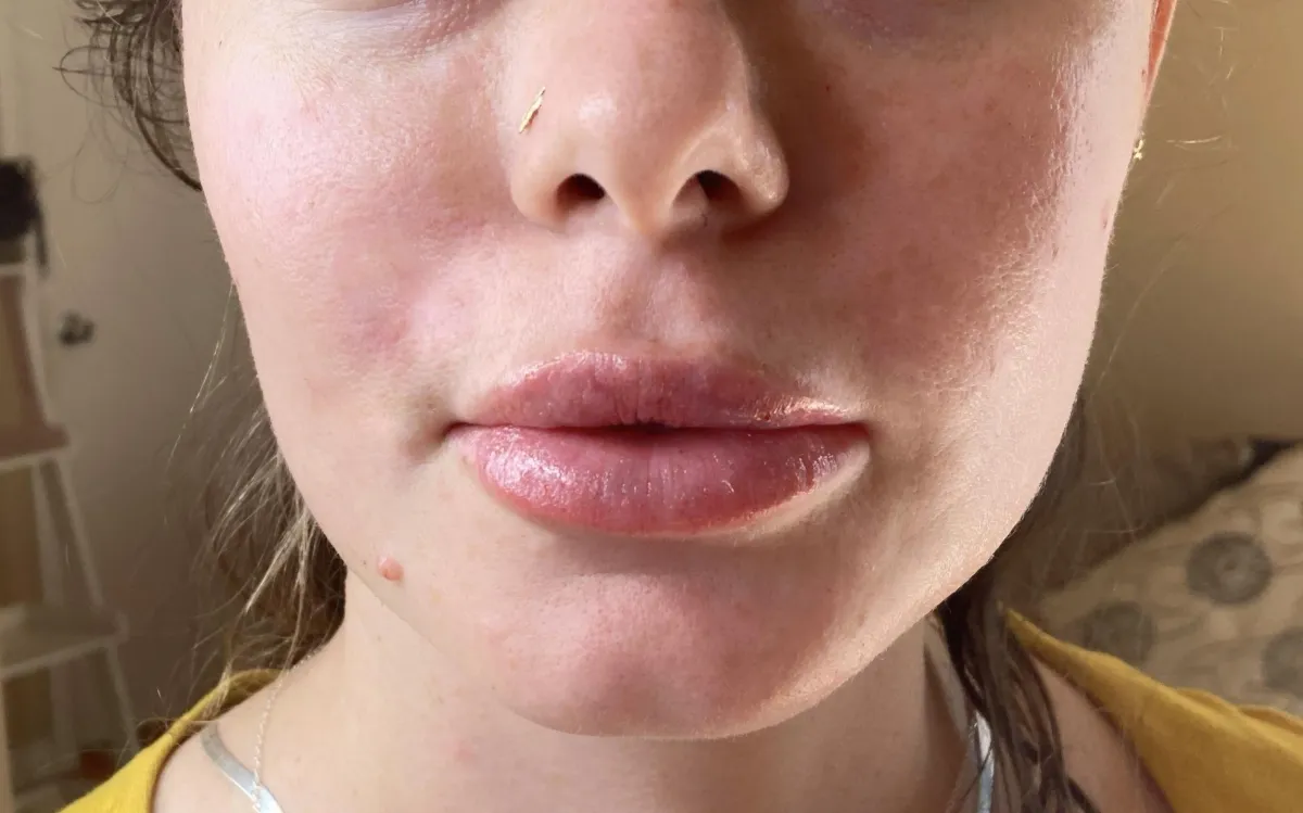 Natural lip plump enhancement on young woman. Full looking lips done with non invasive lip filler technique using the hyaluron pen