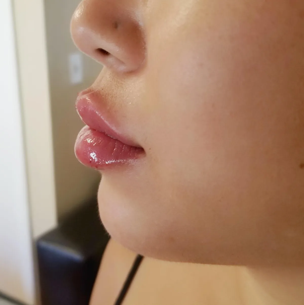 Side profile view of lip enhancement with needle free lip filler using hyaluron pen with lifted defined results