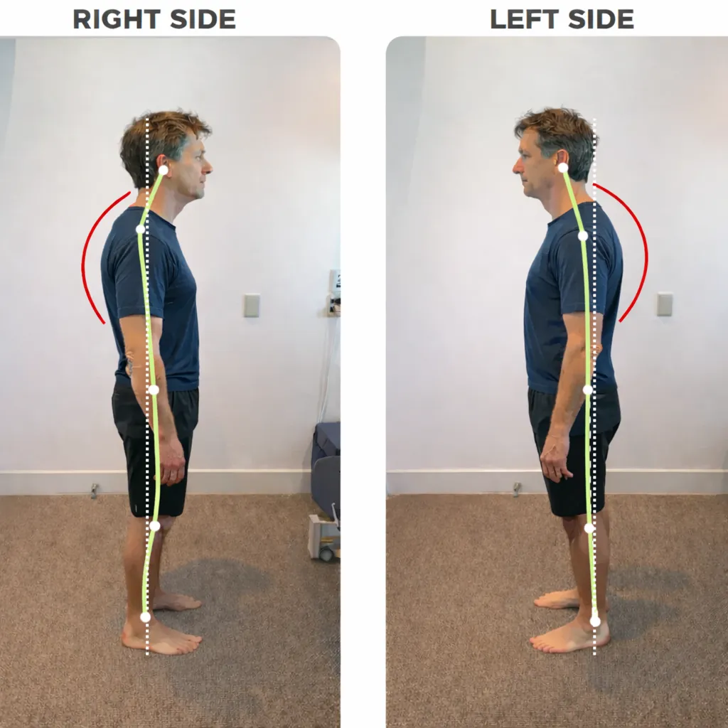Illustration of thoracic kyphosis and whole-body alignment. Example image for education purposes only
