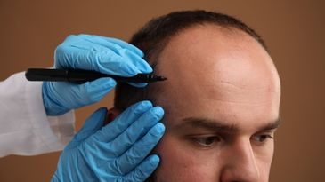 Hair Translant Clinic