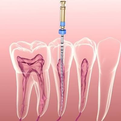 Root canal treatment illustration showing file inside tooth canal