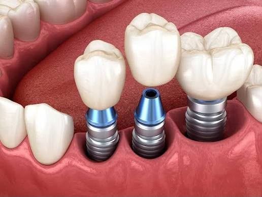 Dental implant model showing titanium post and crown between natural teeth