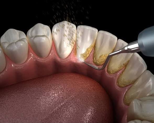 Dental scaling tool removing plaque and tartar from teeth