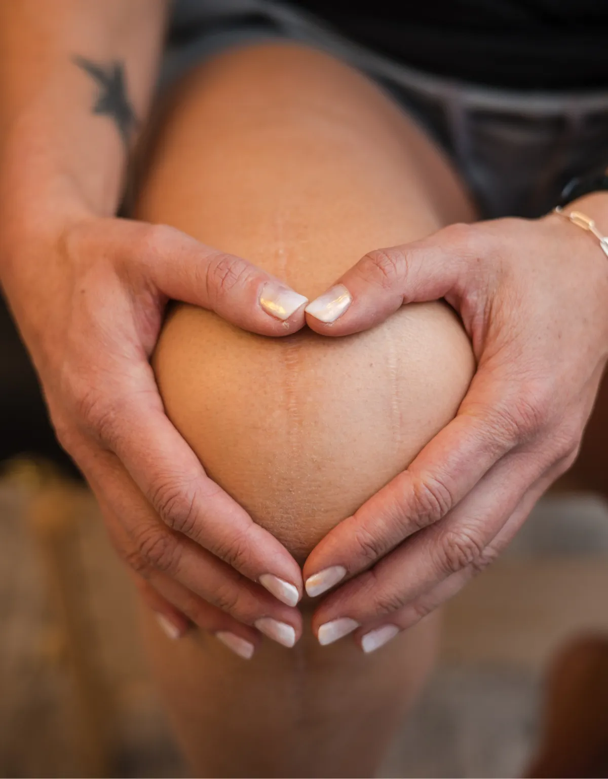 Close-up of a person holding their knee with both hands, showing a healed surgical scar, symbolizing recovery and healing.