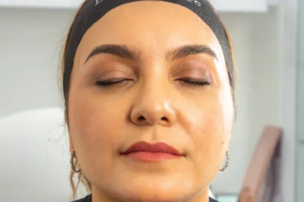 Flacidez facial sin cirugía | Tratamientos en Cartagena