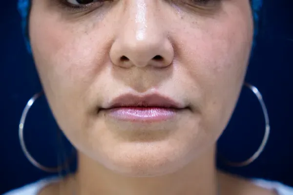 Manchas en la piel | Tratamientos en clima tropical