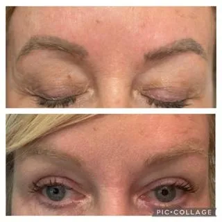 Laser Tattoo Removal 
