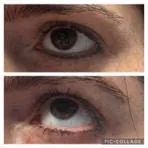 Laser eyeliner removal 
