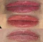 Laser Lip Removal by Robin Hays