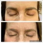 Laser Brow removal 