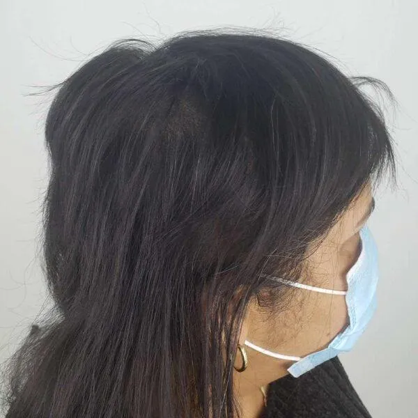 Woman's Hairline after SMP wth Robin Hays 