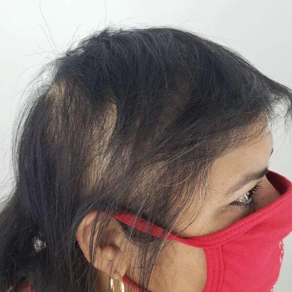 Womans Thinning Hairline Before 