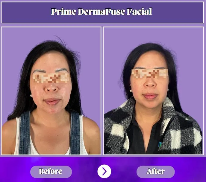 Dermafuse Facial Treatment in San Antonio, TX