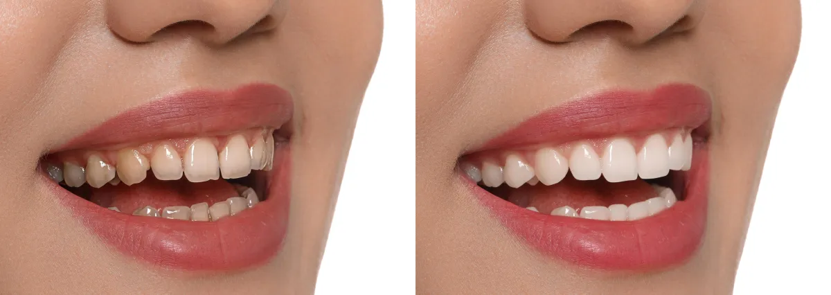 Come cambia realmente un sorriso?
