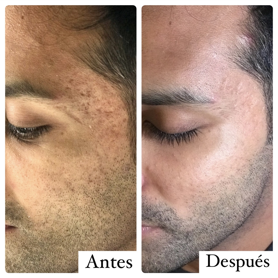 Resultado de paciente - Mamoplastia