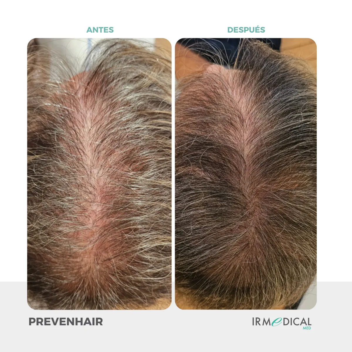 Resultado de paciente - Lifting Facial