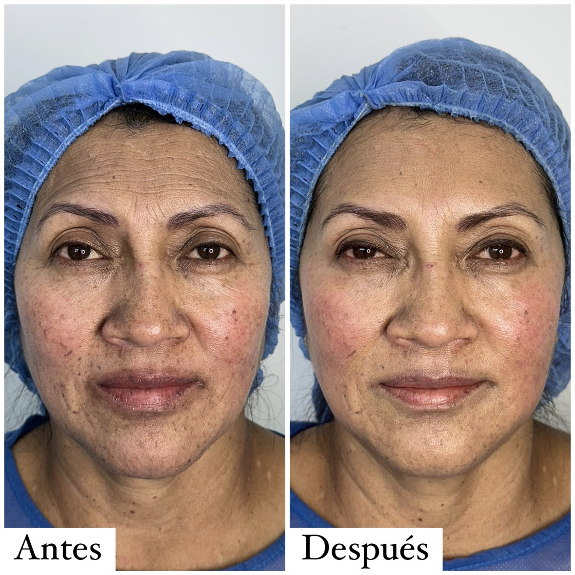 Resultado de paciente - Abdominoplastia