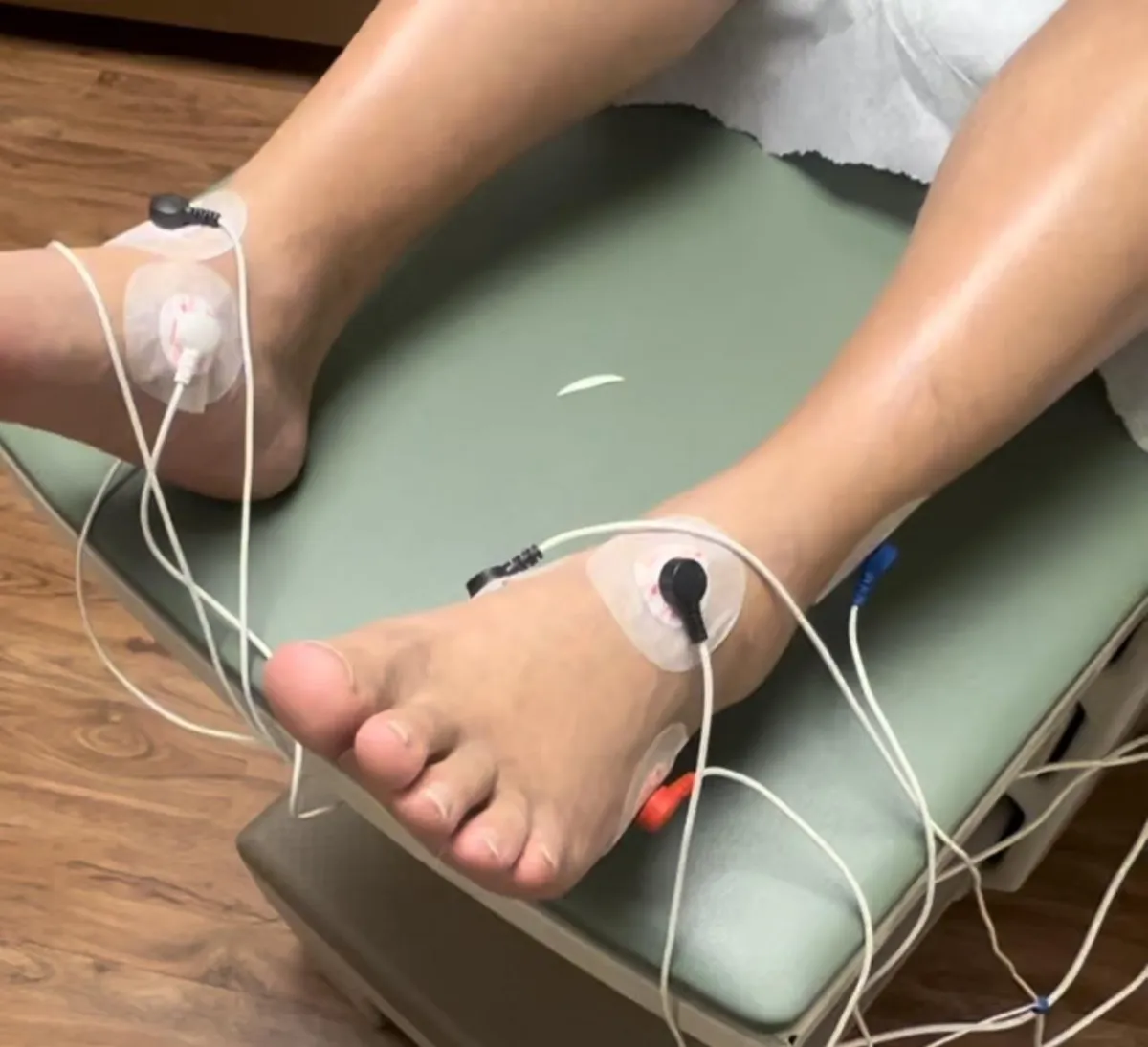 Small Fiber Neuropathy Defeated by Scrambler Therapy - Calmare Therapy