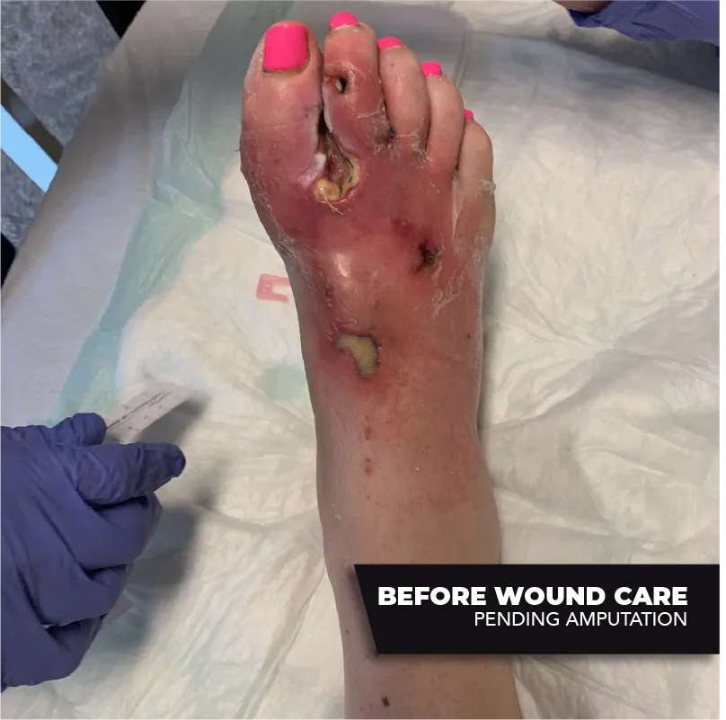 wound care treatment- before