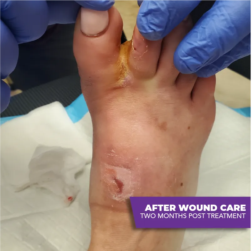wound care treatment- after