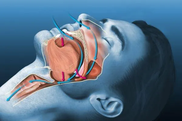 snoring sleep apnea treatment