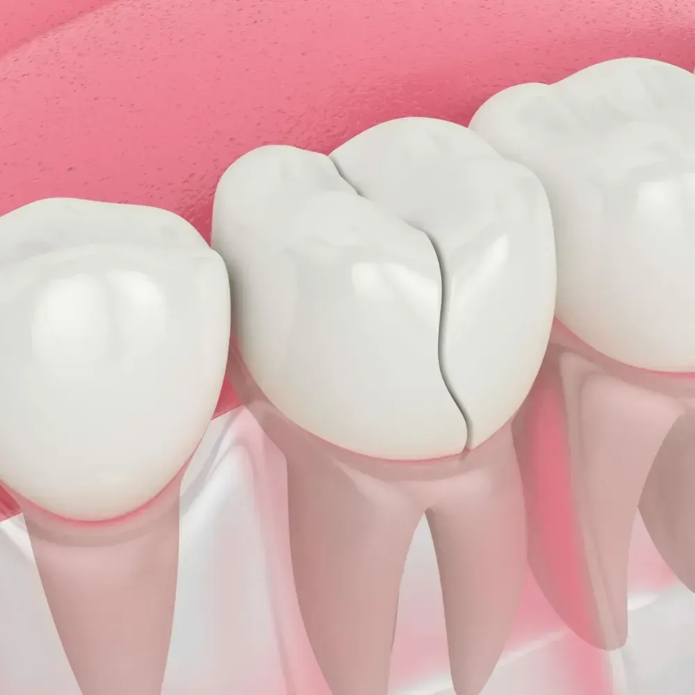 Broken or Cracked Tooth