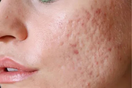 Cicatrici post acnee tament laser CO2