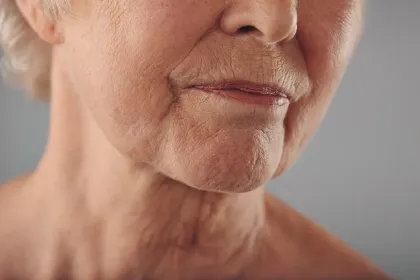 Laser CO2 Ridui si Laxitate piele