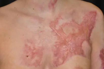 Cicatrici post arsura trament laser CO2