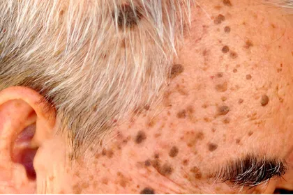 leziuni piele laser co2 sibiu keratoze