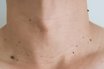 leziuni piele laser co2 sibiu papiloame gat pleoape