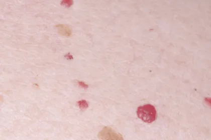 leziuni piele laser co2 sibiu angioame prosi corp ncte 