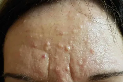 leziuni piele laser co2 sibiu glande sebacee frunte papule