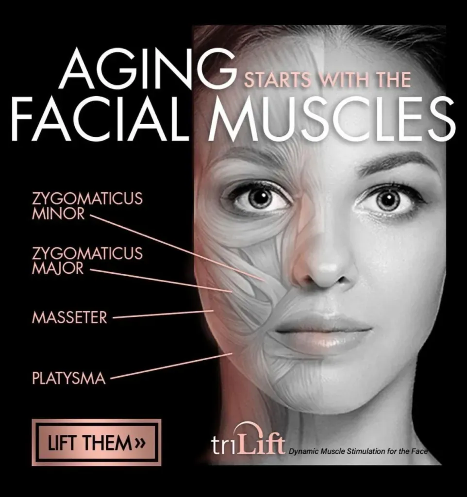 Illustration of facial muscles showing areas treated with TriLift, including zygomatic muscles, masseter, and platysma, highlighting how lifting starts with the facial muscles.