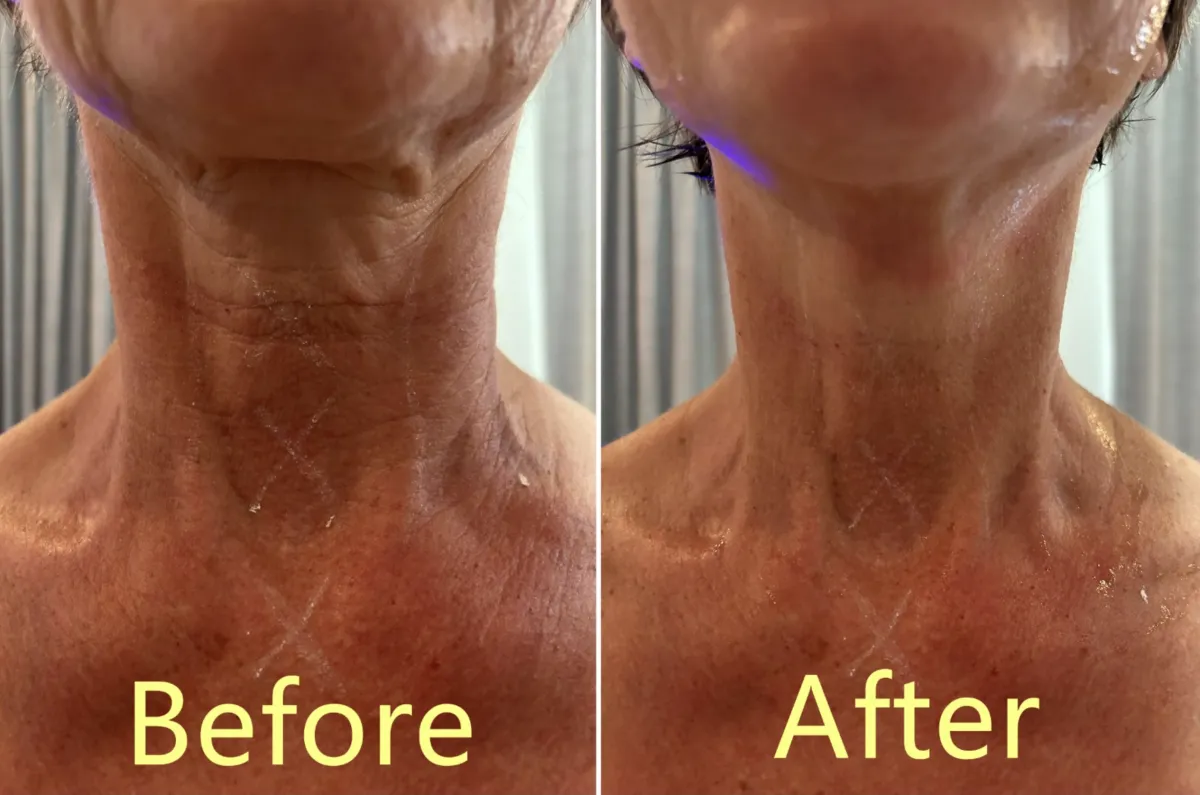 Neck lift for a tighter neck non surgical