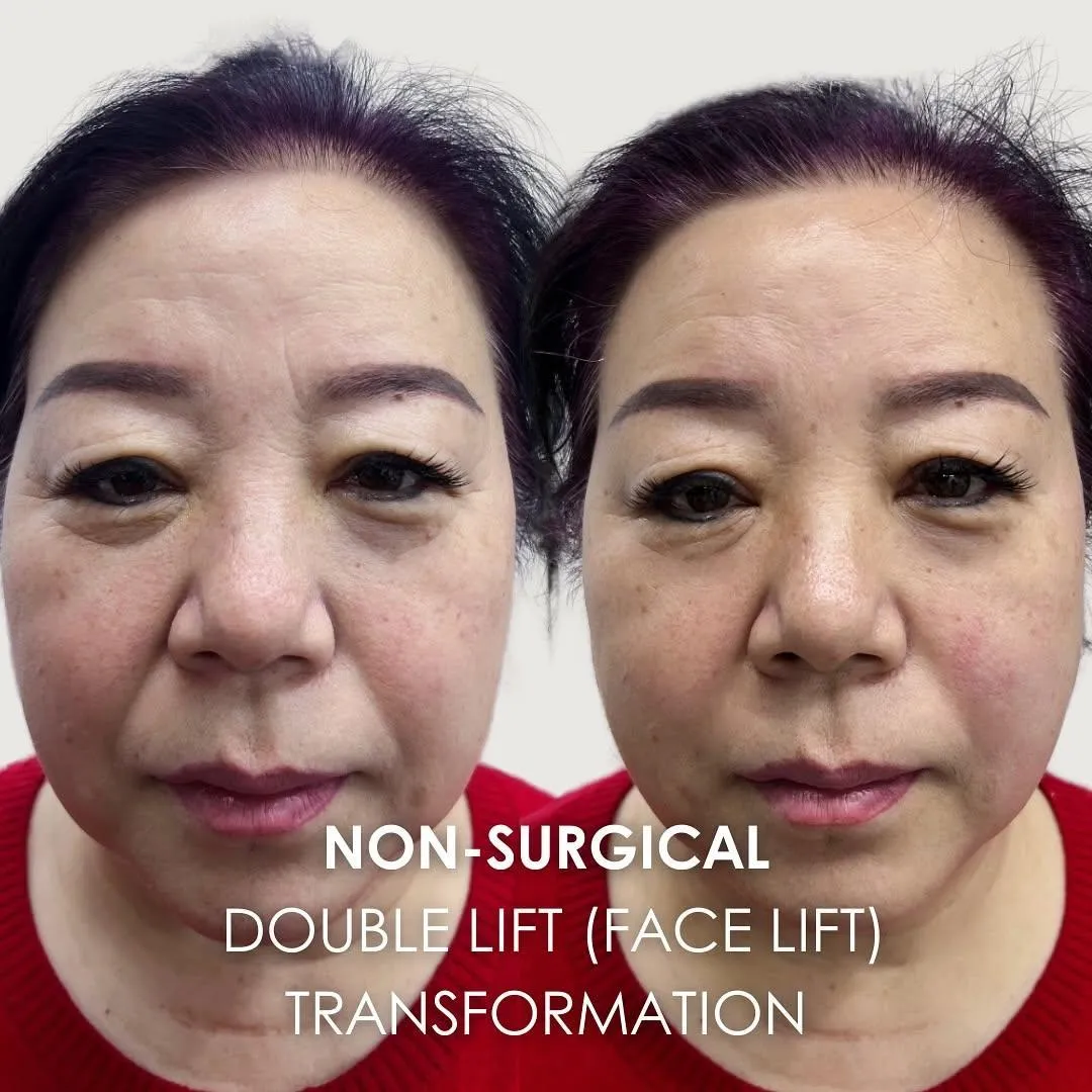 Londons most experienced non surgical face lift