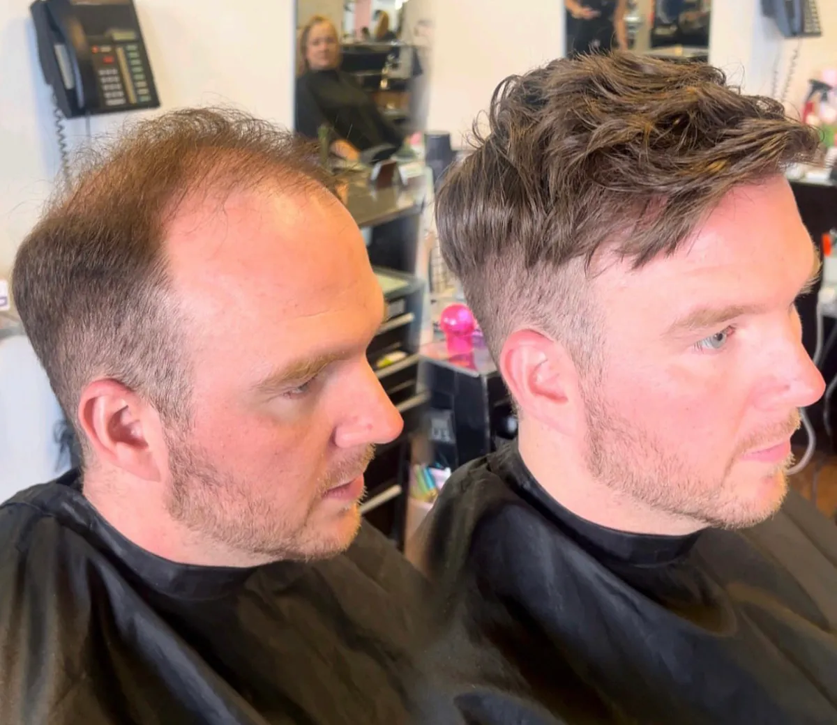 Hair Replacement Cincinnati 